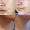 ENVOL pretti Neckliju Cold Plasma Beauty Device