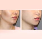 DERMA BUILD Bortide Balloon Ampoule 10ml - Image 2